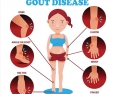 Lựa chọn và sử dụng thuốc hạ acid uric trong điều trị bệnh Gout