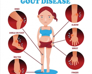 Lựa chọn và sử dụng thuốc hạ acid uric trong điều trị bệnh Gout